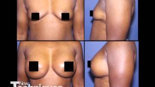 Breast Implants With Before And After Pictures