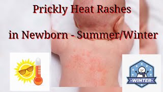 Prickly Heat Rashes in NEWBORN why it causes How to Treat #babycaretips #viralvideo#newborn#heatrash