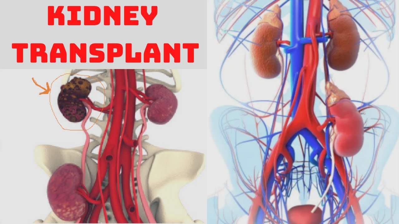 Kidney Transplant - How Serious Is A Kidney Transplant? - Side Effects ...