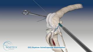 CCL Rupture ExtraCapsular Stabilization with EXTRATAPE®