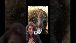 REAL Androgenetic Alopecia SUCCESS Story With Amazing Hair Saviour✨