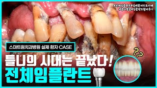 전체임플란트 실제 환자케이스 리뷰로 알아보는 임플란트 수술 및  치료과정, 치료결과! (전악임플란트 수술 전 필수 시청!)