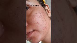 Watch this before using Tretinoin| unbelievable 💯 ||Worst to Best 🤞