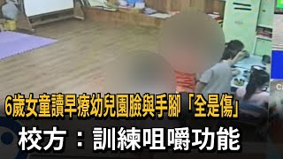 6歲女童讀早療幼兒園臉與手腳「全是傷」校方：訓練咀嚼功能－民視新聞