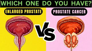 Symptoms Comparison: BPH vs Prostate Cancer
