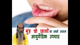 मुहं के छालों के घरेलू उपचार । Home remedies for Mouth Ulcers | Sanskriti tv |