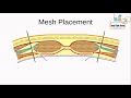 ventral hernia surgery planes for mesh placement terminology demystified