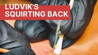 Ludvik's Squirting Back Full Of Blackheads (New Patient, 1st Session)