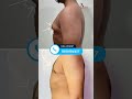 grade 2a gynecomastia surgery result before and after 360° surgery of male breast image