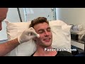 male cheek filler at facelove by facecoach trainer mike clague aesthetic nurse bsc