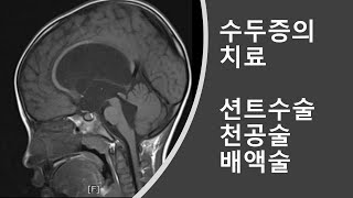 수두증 (Hydrocephalus) 강의  5 : 수두증의 치료. 서양의학의 치료법. 션트수술. 제3뇌실천공술. 뇌실외배액술. 적응증과 문제점.