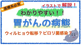 教科書をわかりやすく！「胃がんの病態とは？」〜転移様式やピロリ菌感染を簡単に解説！〜