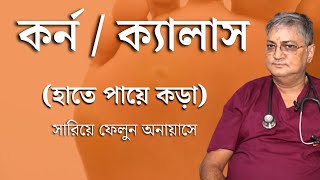 কর্ন / ক্যালাস / হাত-পা এর কড় কারণ, লক্ষণ এবং চিকিৎসা - Foot Corn Remove without pain only 5 minutes