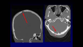 Head to Head: Skull lesion