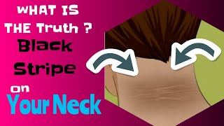 What Is The Terrible Truth of Black Stripe on Your Neck? | You Can't Imagine