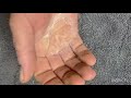 hard skin removal callus on an overworked palm