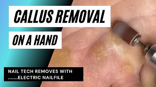 HARD SKIN REMOVAL, CALLUS ON AN OVERWORKED PALM