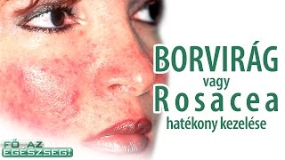 Borvirágos bőr, vagyis a Rosacea és visszér hatékony kezelése - Fő az egészség!