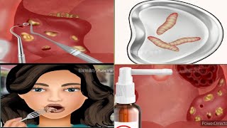 ASMR _remove _ mouth _ worm | mouth Of _cleaning | How to remove mouth worms