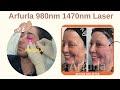 arfurla 980nm 1470nm endolaser liposuction lipolysis laser equipment