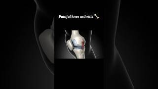 painful knee joint | arthritis | 3D Animations #3danatomy #kneepain #kneejoint