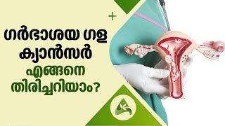 How to detect Cervical Cancer? | ഗർഭാശയ ഗള ക്യാൻസർ എങ്ങനെ തിരിച്ചറിയാം? | Arogya Kaumudy