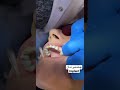 چاندنى ددان به بورغوو لەلایەن دکتۆرە دیمەن ا implant teeth_implant doctor dentist ddan clinic