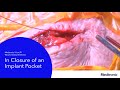 V-Loc™ Wound Closure Device in Pocket Closure Procedural Video with Dr. Sussman