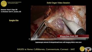 Laparoscopic removal of retroperitoneal tumor with maneuver of hanging IVC