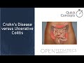 Crohn's Disease versus Ulcerative Colitis by J. Ouahed, L. Collen | OPENPediatrics