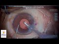 extreme shallow AC on table dilatation Dr Sourabh Patwardhan Live #cataract  surgery