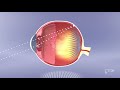 Myopia Management (english) - Ortho-K