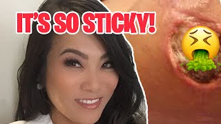 10 of The BIGGEST Removals EVER seen by Dr. Pimple Popper!