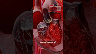 What causes Aortic Valve Stenosis and How it affects the body? Part 1