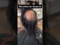 Microlinks for Alopecia!                  MicrolinksHairBar.com