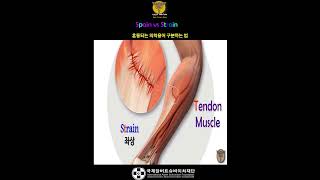 Sprain (염좌) vs Strain (좌상) | 혼동되는 의학용어 구분하는 법 ⑤ | 연상암기법