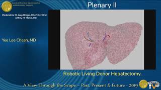 Robotic Living Donor Hepatectomy