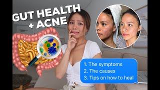 How healing your gut can heal your acne ll GUT HEALTH AND ACNE