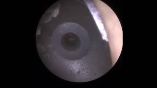 818 - Emergency Extraction of Large Hearing Aid Powerdome Ear Wax Removal