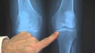 Joint Replacement Surgery (part 1 of 6) - What is a Joint?