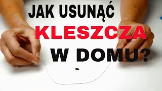 Jak Usunąć KLESZCZA? Jak Wyjąć KLESZCZA?