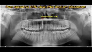 Single upper incisor flapless compressive implant