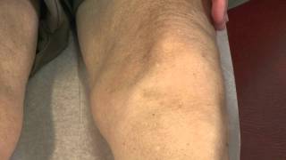 Effusion Bulge Sign