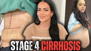 Throwing Up Blood & Still Drinking | Stage 4 Cirrhosis, Liver Transplant & 19 Months Sober