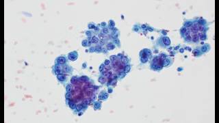 Mesothelioma cytology