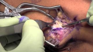 Lateral Epicondylitis Surgery