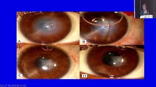 AIOC2024  GP160 Topic  Dr  Vishal jhanji Acute Corneal Hydrops