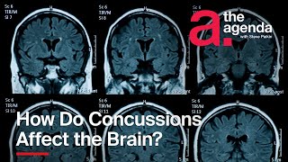 How Do Concussions Affect the Brain? | The Agenda