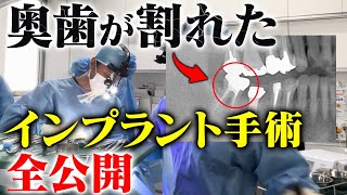 15年前に入れた奥歯が割れた患者をインプラントで救います