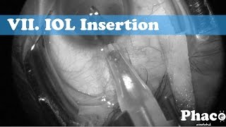 Phaco Annotated | VII. IOL insertion